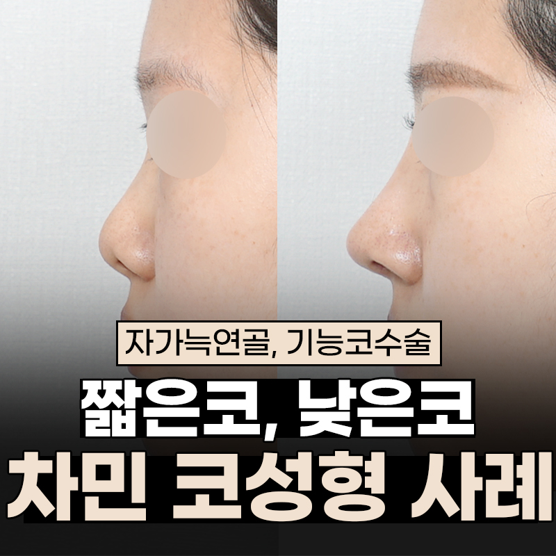 코수술 자가늑 1개월 : 짧은코, 들창코 케이스 리뷰 관련 이미지 1