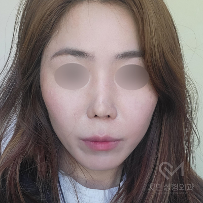 Ninth Revision Rhinoplasty for Contracted Nose: Pinched Nose, Depression, Autologous Rib Cartilage, Saddle Nose image 17