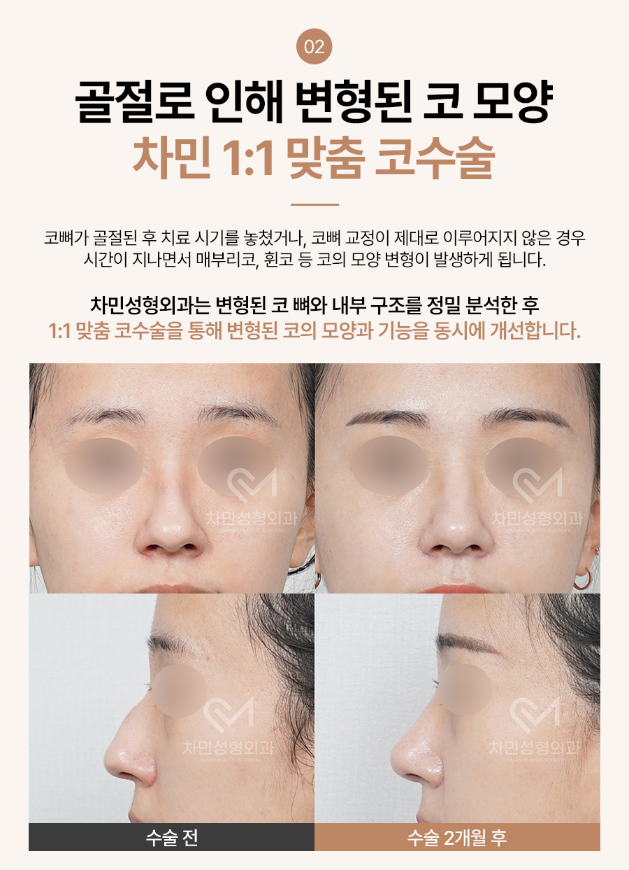 코뼈 골절 병원, 수술, 부러짐 증상이 느껴질 때 당일 진료! 관련 이미지 12