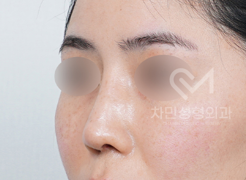 Ninth Revision Rhinoplasty for Contracted Nose: Pinched Nose, Depression, Autologous Rib Cartilage, Saddle Nose image 12