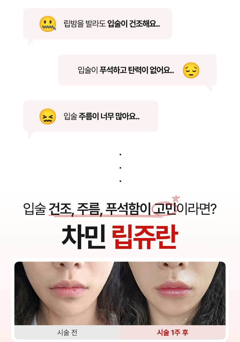 립쥬란 입술주름과 건조함이 고민이라면 차민성형외과 관련 이미지 2