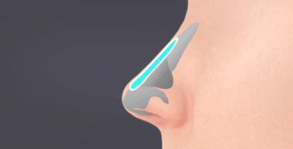 Case Review of Total Nose Removal (Removal of Donated Rib Cartilage, Cartilage Repositioning) ｜Director Minseong Kim image 1