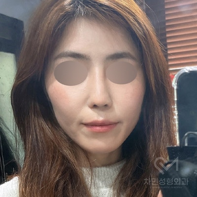 Ninth Revision Rhinoplasty for Contracted Nose: Pinched Nose, Depression, Autologous Rib Cartilage, Saddle Nose image 20