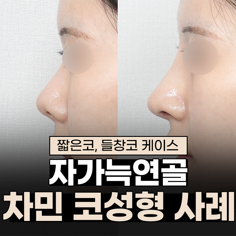 2 Weeks After Rib Cartilage Rhinoplasty: Short Nose Surgery Review, Columella Correction Case image 14