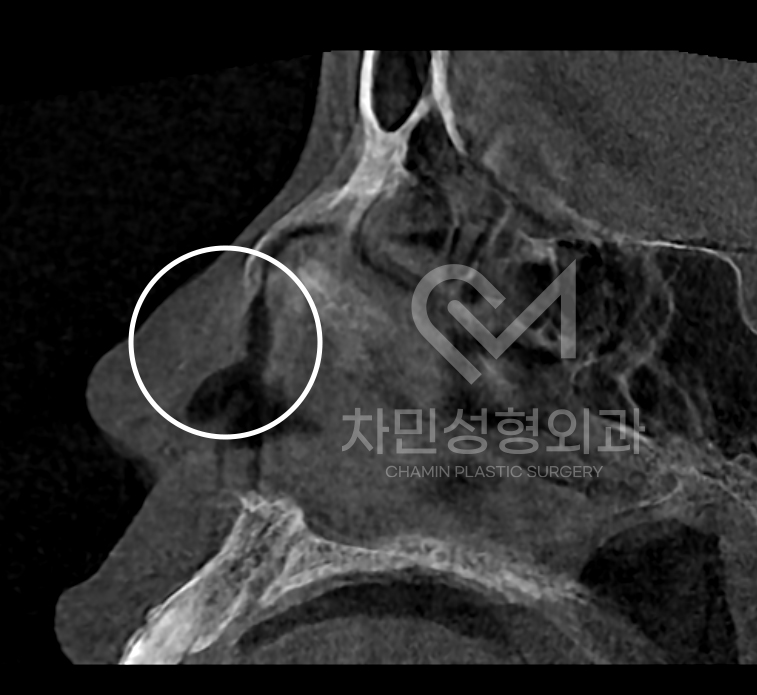 Ninth Revision Rhinoplasty for Contracted Nose: Pinched Nose, Depression, Autologous Rib Cartilage, Saddle Nose image 6
