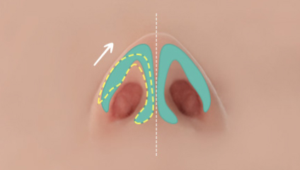 Case Review of Total Nose Removal (Removal of Donated Rib Cartilage, Cartilage Repositioning) ｜Director Minseong Kim image 11