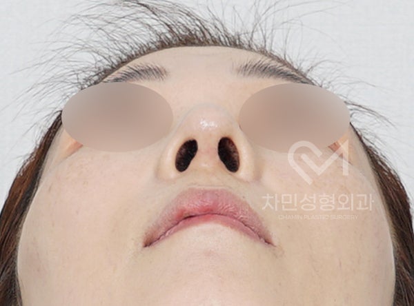 Removal of Nose Silicone, Ear Cartilage, Medpor, and Tip Cartilage Repositioning (Before Surgery ~ 2 Months) image 11