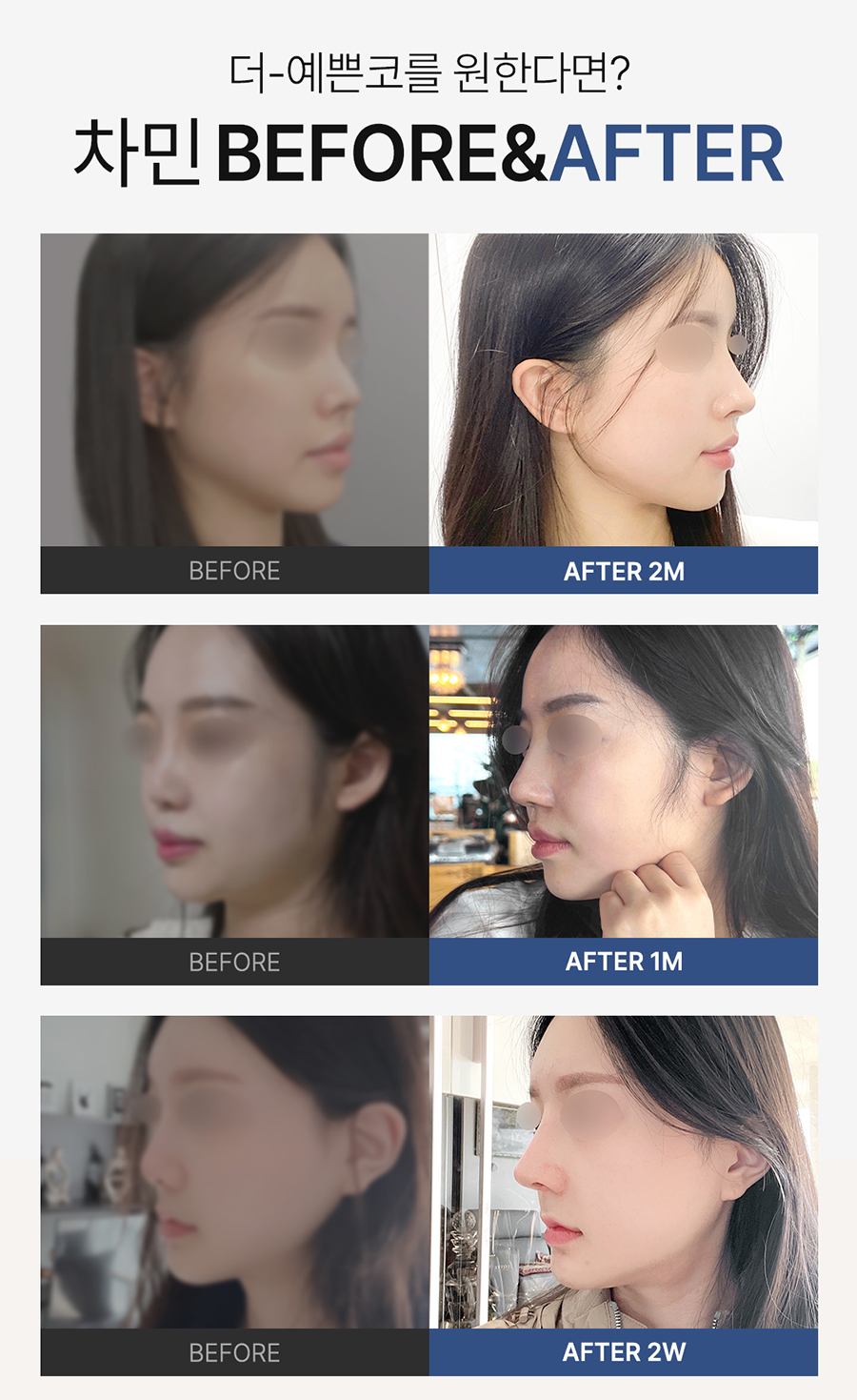 Cha Min Plastic Surgery’s All Nose Care Solution, from Nose Surgery to Nasal Reconstruction! image 12