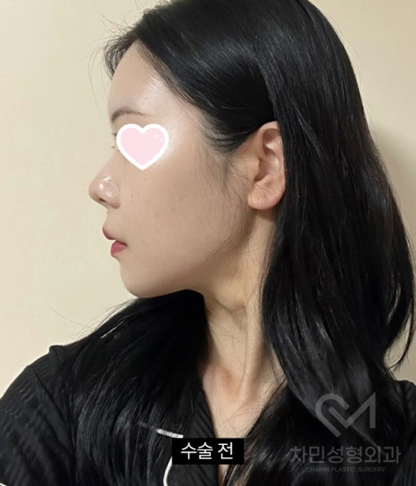 2 Weeks After Rib Cartilage Rhinoplasty: Short Nose Surgery Review, Columella Correction Case image 7