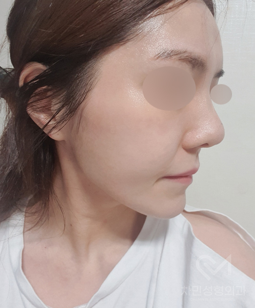 튀어나온 메드포어 제거, 실리콘,  비주 피부 결손, 돌출 및 패임, 염증 진행 중 관련 이미지 17