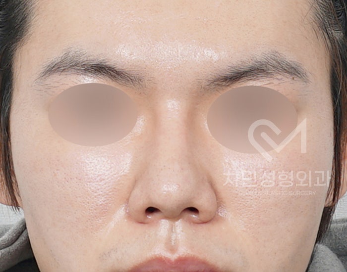 코재건 수술 (안장코, 찝힌코, 함몰, 구축) 극한코 사례 관련 이미지 7