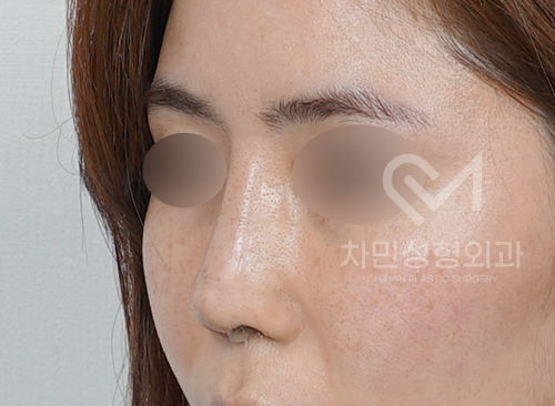 Ninth Revision Rhinoplasty for Contracted Nose: Pinched Nose, Depression, Autologous Rib Cartilage, Saddle Nose image 7