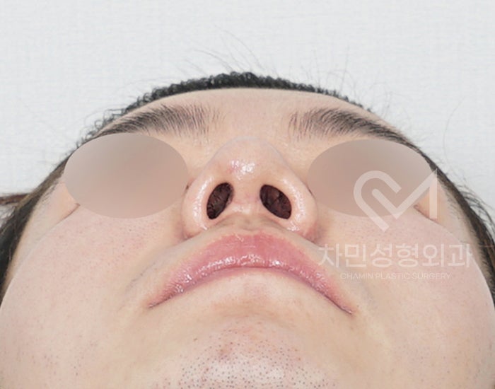 코재건 수술 (안장코, 찝힌코, 함몰, 구축) 극한코 사례 관련 이미지 9