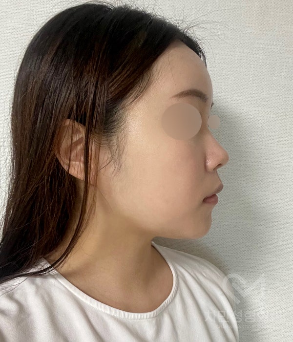 Female Straight Nose: Case Review of a Well-Known Rhinoplasty Clinic! image 8