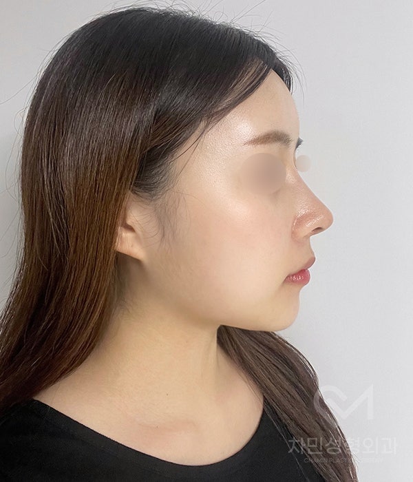 Female Straight Nose: Case Review of a Well-Known Rhinoplasty Clinic! image 9