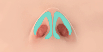 Case Review of Total Nose Removal (Removal of Donated Rib Cartilage, Cartilage Repositioning) ｜Director Minseong Kim image 2