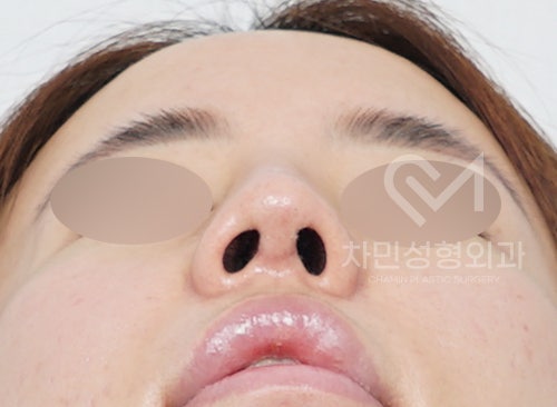 코수술 후 구축으로 짧고 들린 코 (휜코, 코끝 길이 연장, 자가늑연골) 관련 이미지 10
