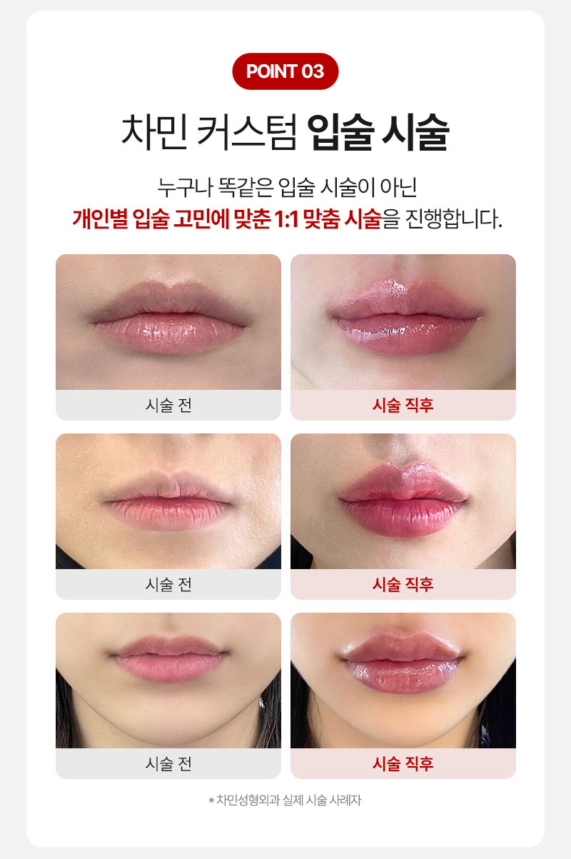 립쥬란 입술주름과 건조함이 고민이라면 차민성형외과 관련 이미지 7