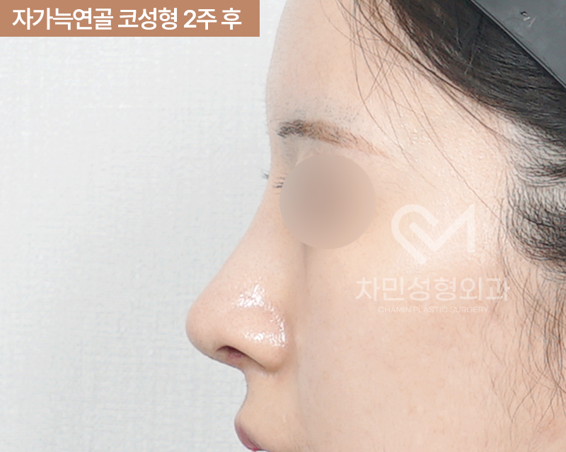 2 Weeks After Rib Cartilage Rhinoplasty: Short Nose Surgery Review, Columella Correction Case image 6