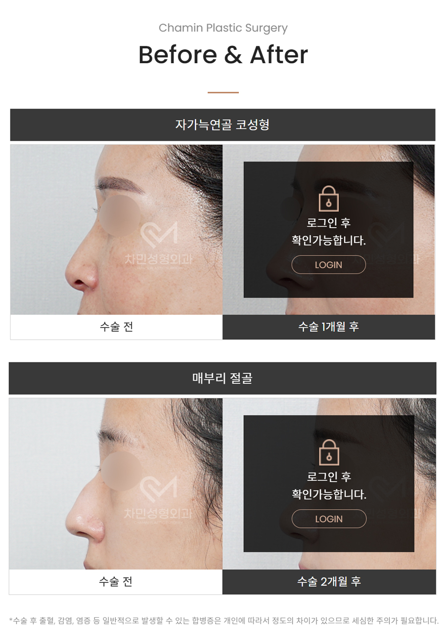 Female Straight Nose: Case Review of a Well-Known Rhinoplasty Clinic! image 12