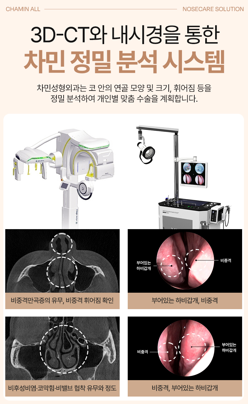 코수술 자가늑 1개월 : 짧은코, 들창코 케이스 리뷰 관련 이미지 10