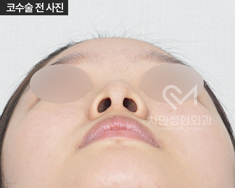 코수술 자가늑 1개월 : 짧은코, 들창코 케이스 리뷰 관련 이미지 3