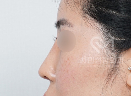 Ninth Revision Rhinoplasty for Contracted Nose: Pinched Nose, Depression, Autologous Rib Cartilage, Saddle Nose image 14