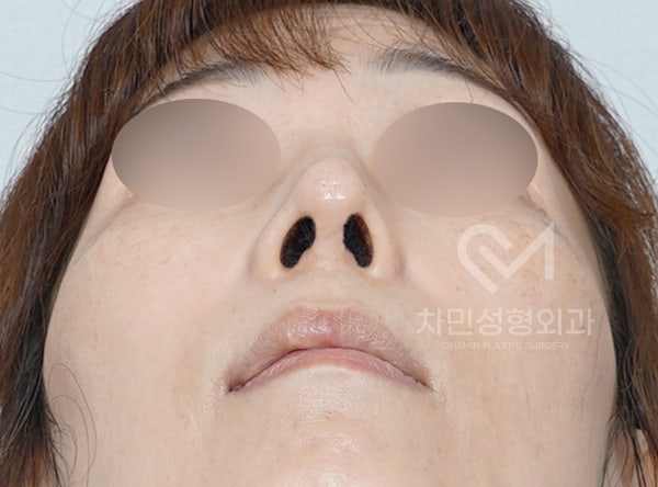 Removal of Nose Silicone, Ear Cartilage, Medpor, and Tip Cartilage Repositioning (Before Surgery ~ 2 Months) image 10