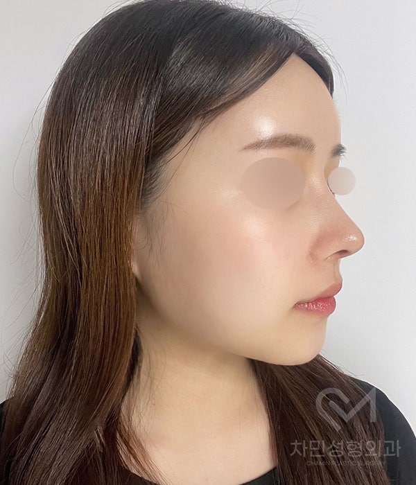 Female Straight Nose: Case Review of a Well-Known Rhinoplasty Clinic! image 11