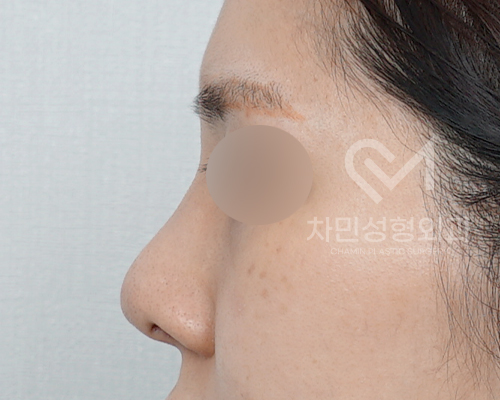 튀어나온 메드포어 제거, 실리콘,  비주 피부 결손, 돌출 및 패임, 염증 진행 중 관련 이미지 4