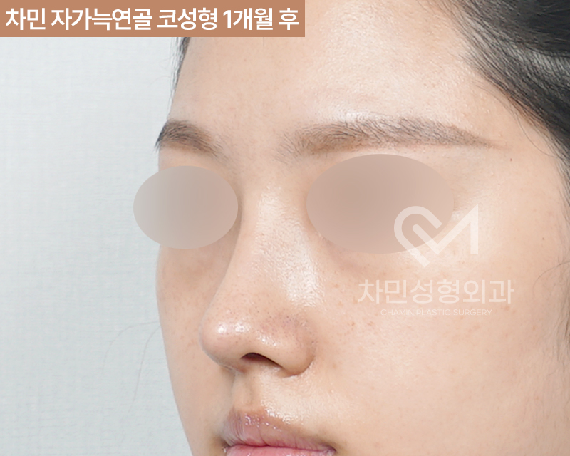 코수술 자가늑 1개월 : 짧은코, 들창코 케이스 리뷰 관련 이미지 7