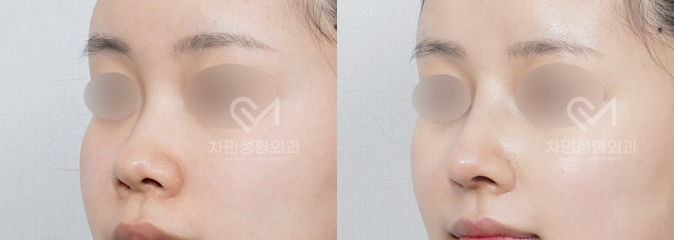 Female Straight Nose: Case Review of a Well-Known Rhinoplasty Clinic! image 6