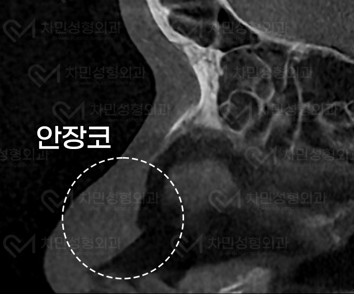 코재건 수술 (안장코, 찝힌코, 함몰, 구축) 극한코 사례 관련 이미지 5