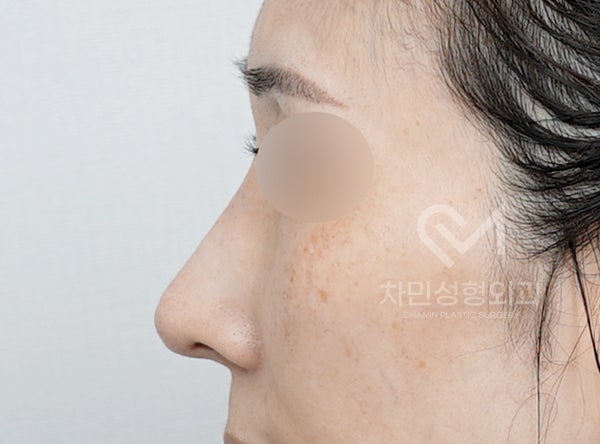 Removal of Nose Silicone, Ear Cartilage, Medpor, and Tip Cartilage Repositioning (Before Surgery ~ 2 Months) image 2