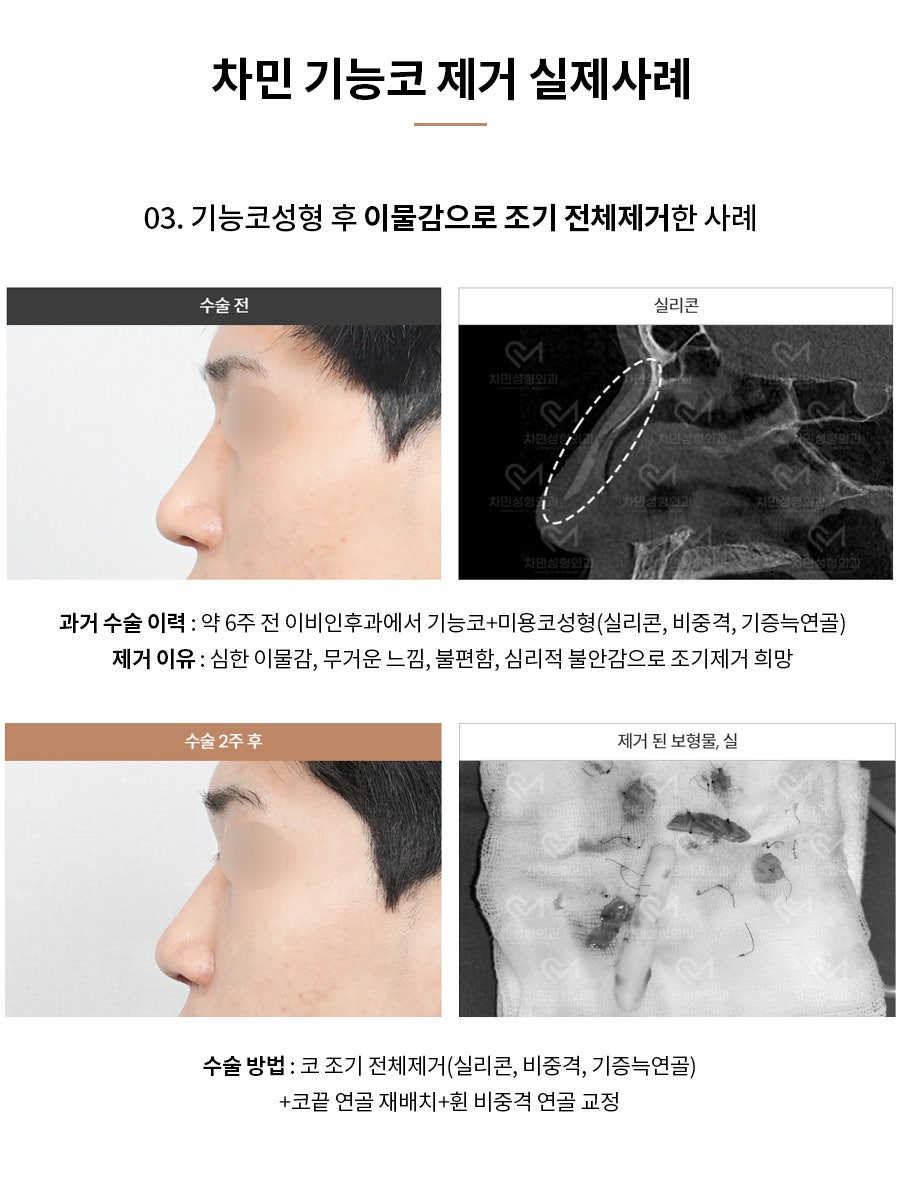 코수술 후 코막힘, 이물감, 불안할 때 [차민 기능코제거] 관련 이미지 7