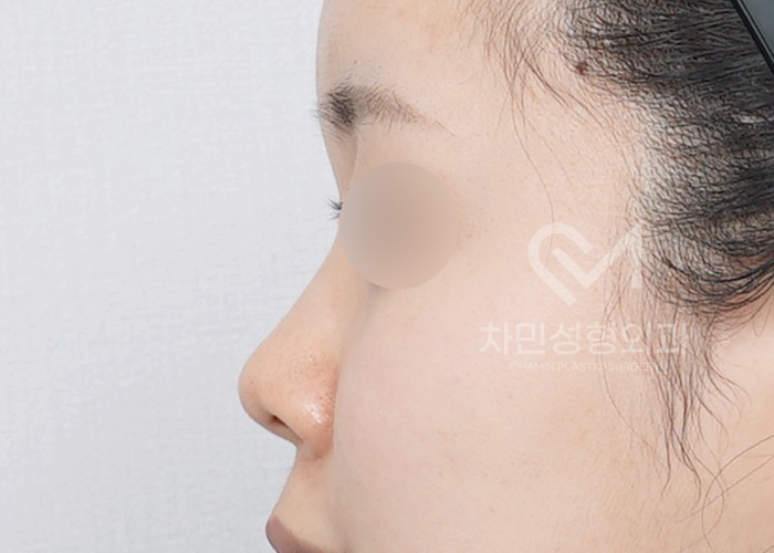 Female Straight Nose: Case Review of a Well-Known Rhinoplasty Clinic! image 3
