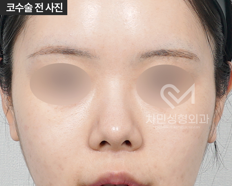 2 Weeks After Rib Cartilage Rhinoplasty: Short Nose Surgery Review, Columella Correction Case image 1
