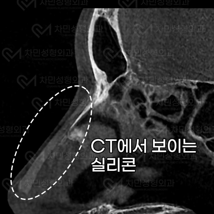 Removal of Nose Silicone, Ear Cartilage, Medpor, and Tip Cartilage Repositioning (Before Surgery ~ 2 Months) image 3
