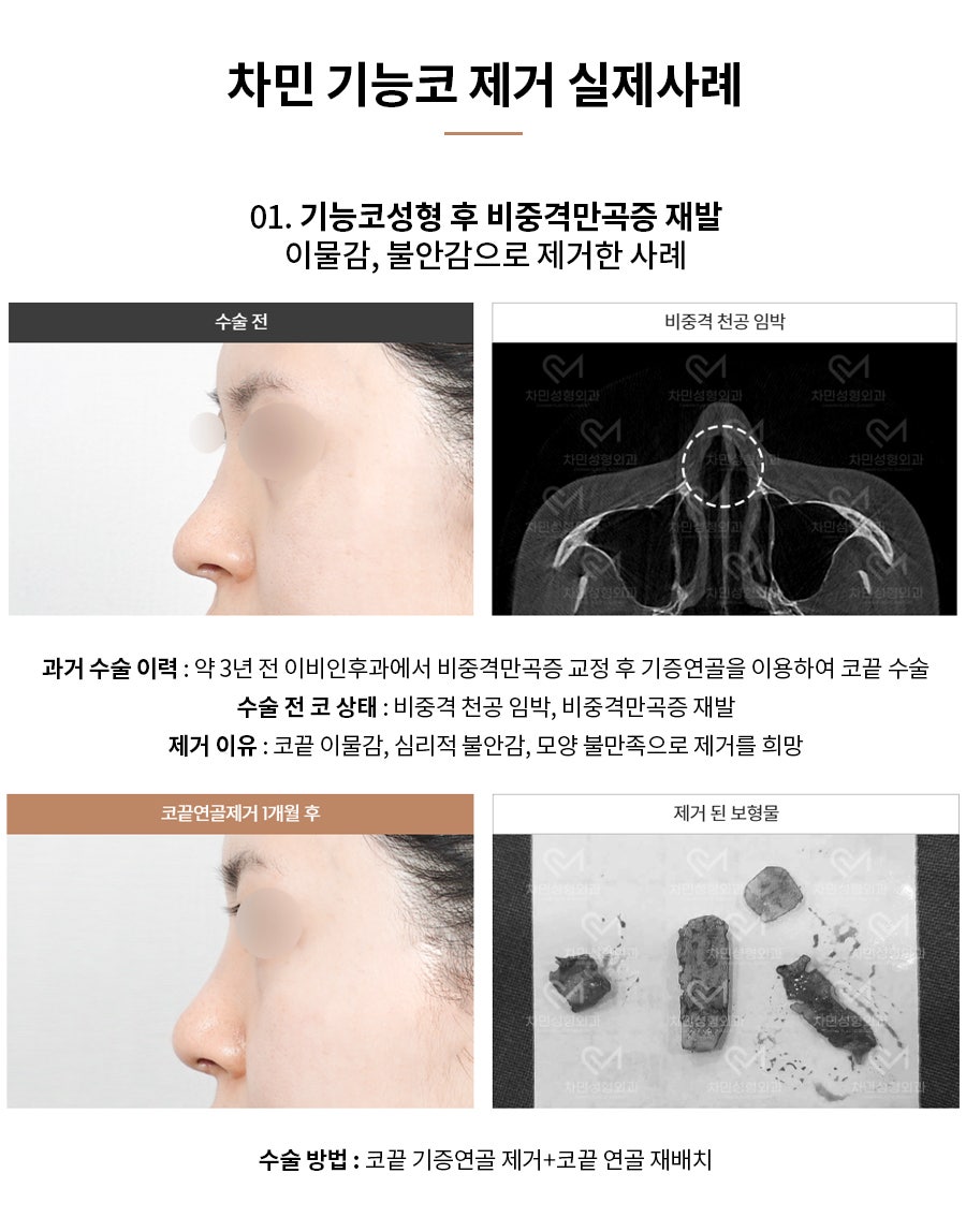 코수술 후 코막힘, 이물감, 불안할 때 [차민 기능코제거] 관련 이미지 5