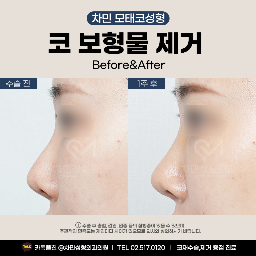 코 보형물 제거 : 차민성형외과에서 모태코로 돌아가기 관련 이미지 7