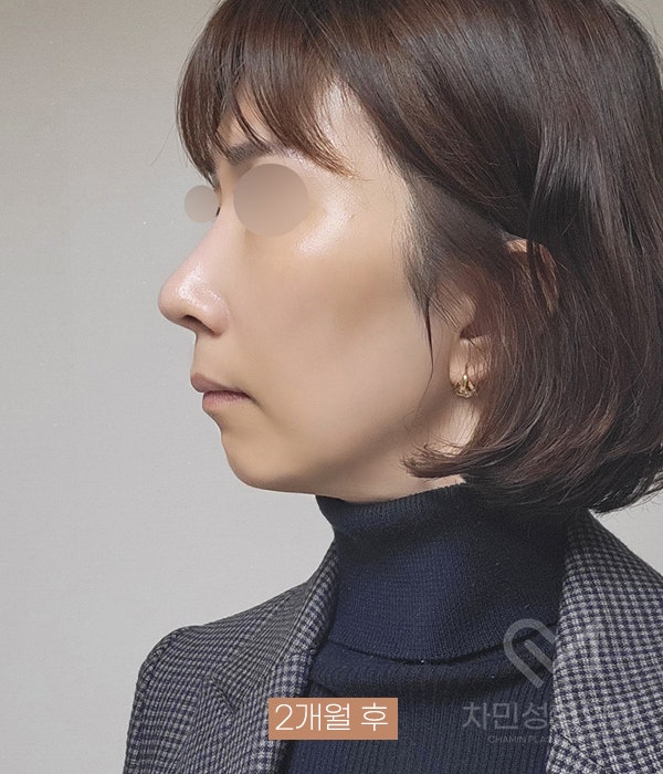 Removal of Nose Silicone, Ear Cartilage, Medpor, and Tip Cartilage Repositioning (Before Surgery ~ 2 Months) image 17