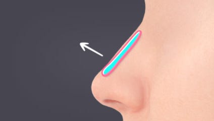 Case Review of Total Nose Removal (Removal of Donated Rib Cartilage, Cartilage Repositioning) ｜Director Minseong Kim image 10