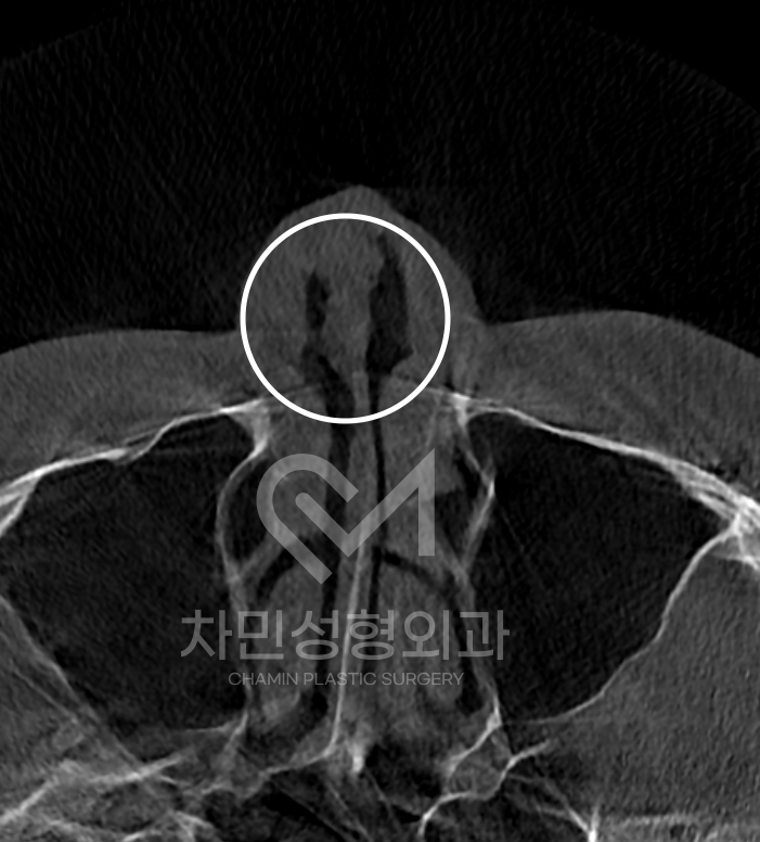 Ninth Revision Rhinoplasty for Contracted Nose: Pinched Nose, Depression, Autologous Rib Cartilage, Saddle Nose image 5