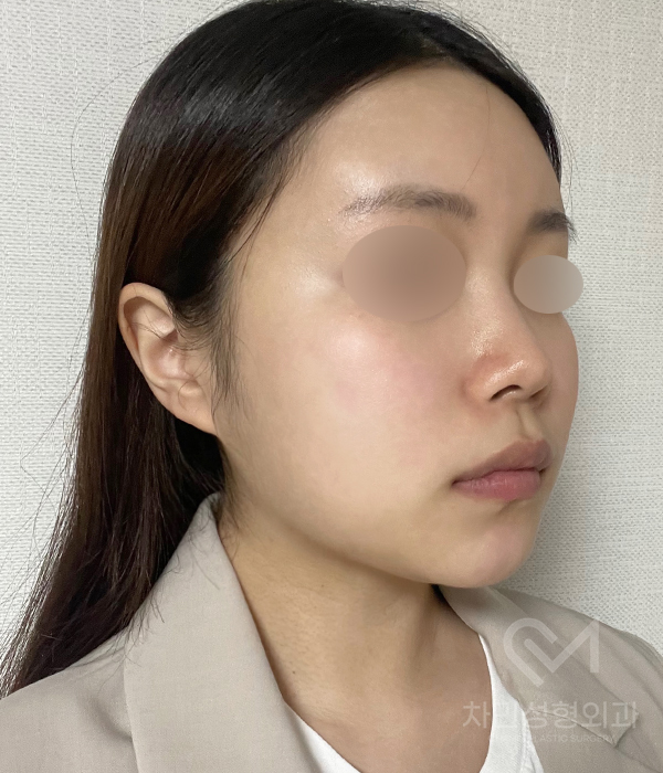 Female Straight Nose: Case Review of a Well-Known Rhinoplasty Clinic! image 10