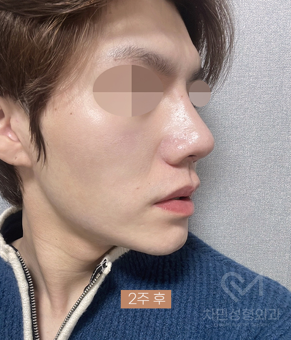 코재건 수술 (안장코, 찝힌코, 함몰, 구축) 극한코 사례 관련 이미지 15