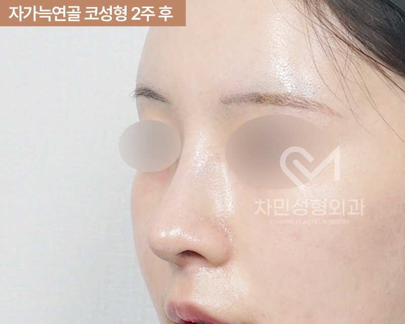 2 Weeks After Rib Cartilage Rhinoplasty: Short Nose Surgery Review, Columella Correction Case image 5