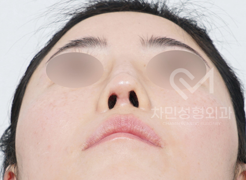 Ninth Revision Rhinoplasty for Contracted Nose: Pinched Nose, Depression, Autologous Rib Cartilage, Saddle Nose image 16
