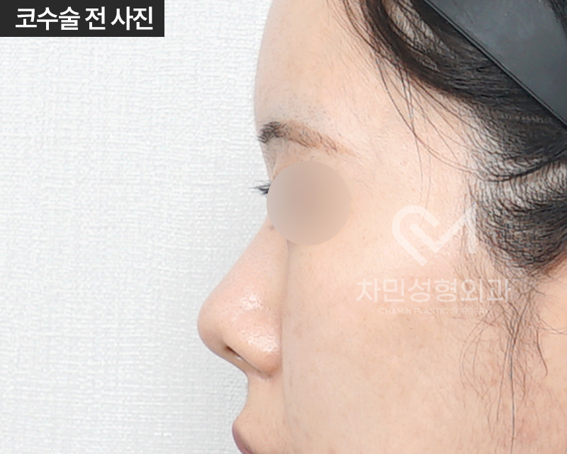 2 Weeks After Rib Cartilage Rhinoplasty: Short Nose Surgery Review, Columella Correction Case image 3