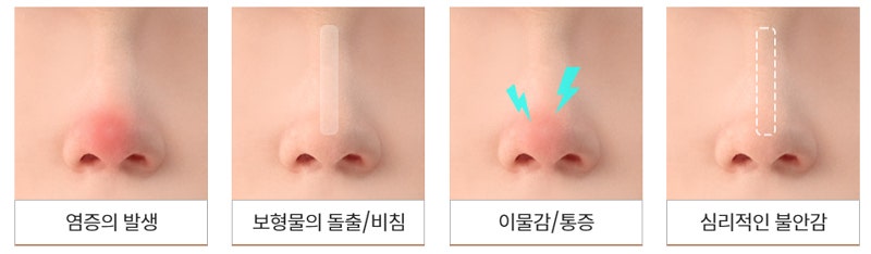 Case Review of Total Nose Removal (Removal of Donated Rib Cartilage, Cartilage Repositioning) ｜Director Minseong Kim image 12
