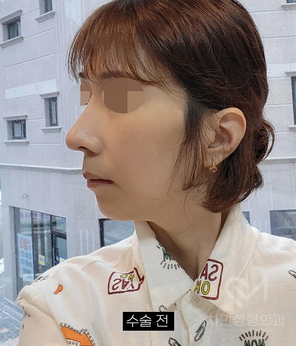 Removal of Nose Silicone, Ear Cartilage, Medpor, and Tip Cartilage Repositioning (Before Surgery ~ 2 Months) image 13